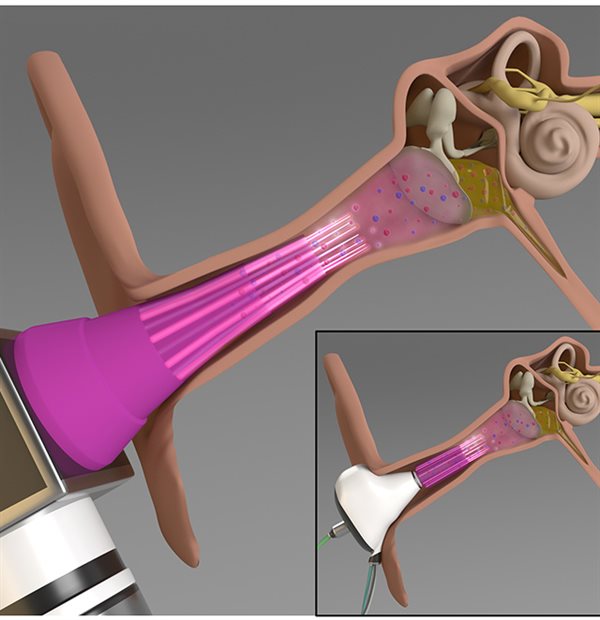 An illustration of the cold plasma-integrated otoscope (main figure) and the earbud (inset) for the potential treatment of middle ear infections.